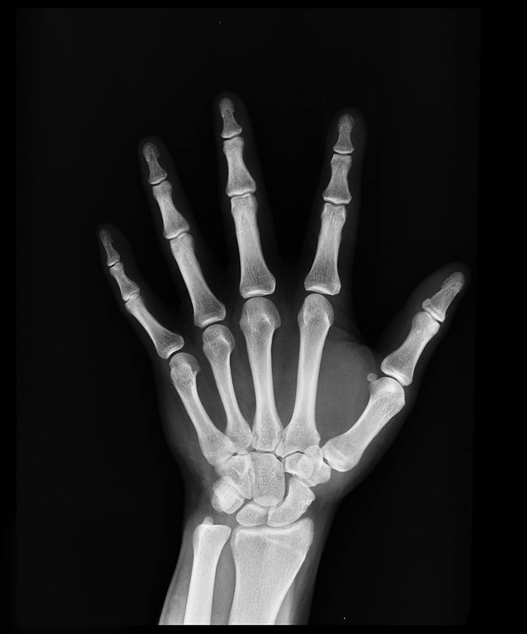 hand x ray result